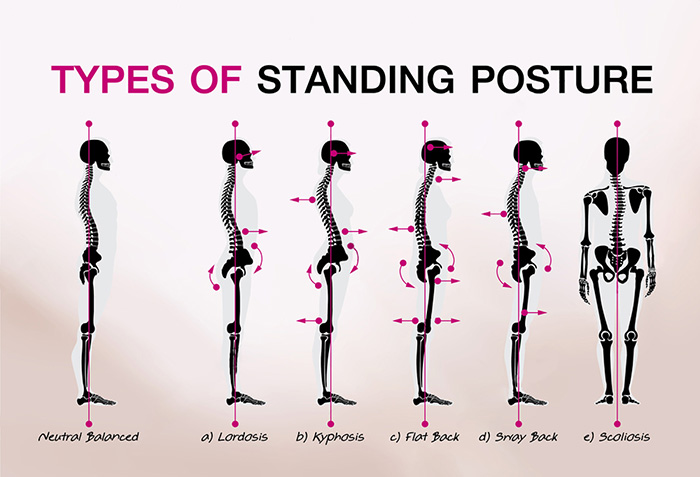 Why You Should Correct Your Posture